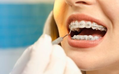 The True Cost Of Clear Braces May Be Cheaper Than You Think